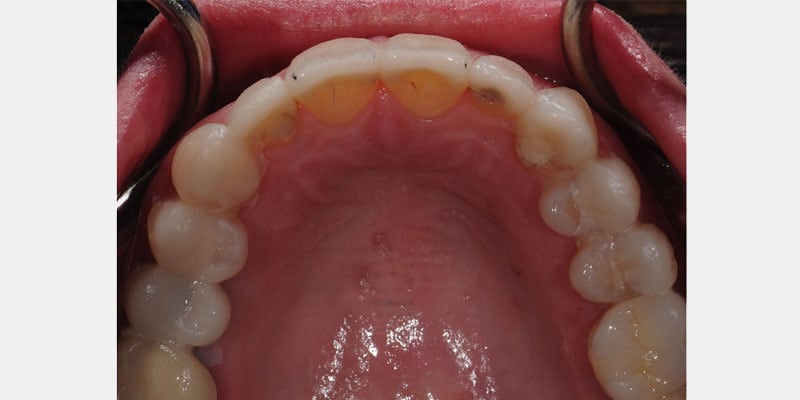 Carillas dentales: la filtración puede empezar en los bordes y avanzar sin aviso