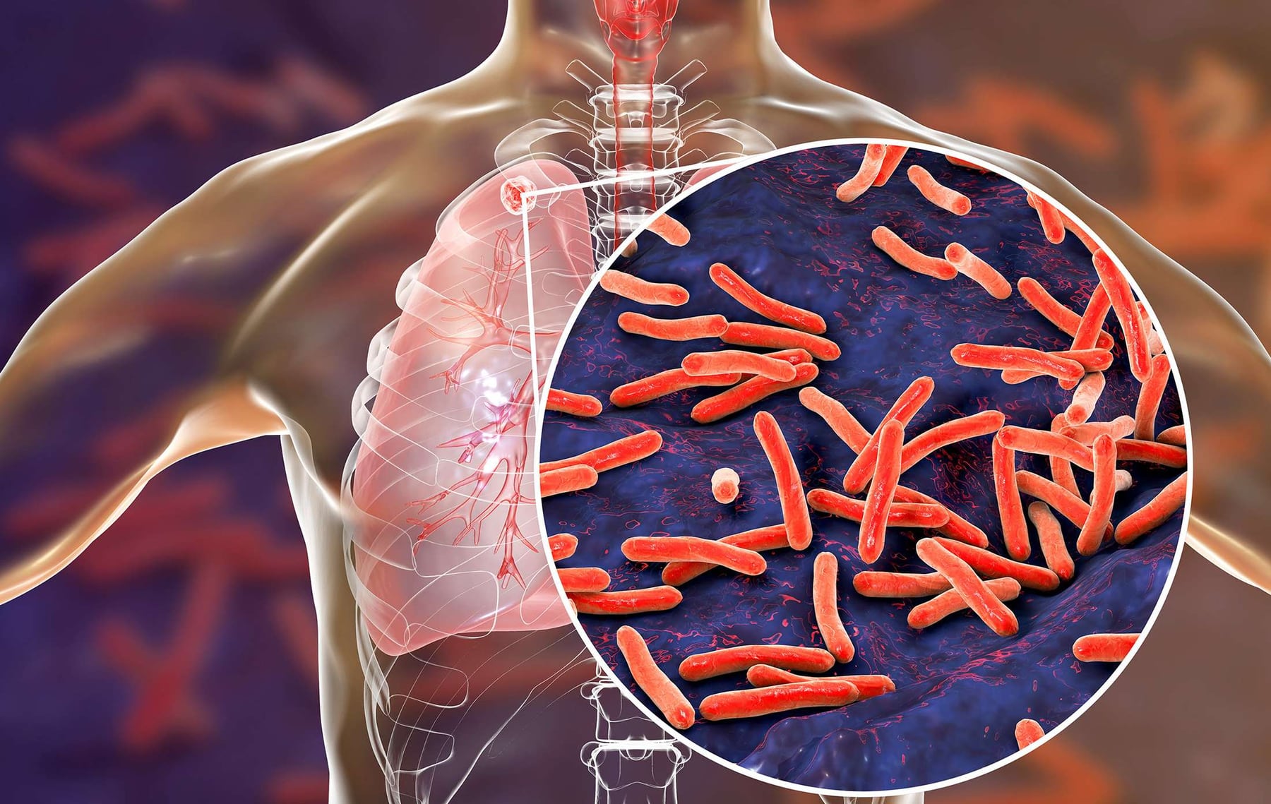 Tuberculosis en alza: los casos crecieron un 38% en Argentina y alertan sobre prevención